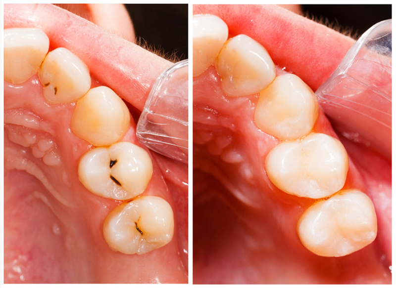 Fillings  Towson, MD 