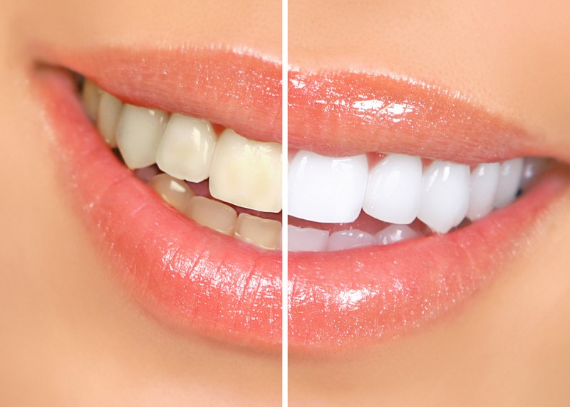 Teeth Whitening  Towson, MD 