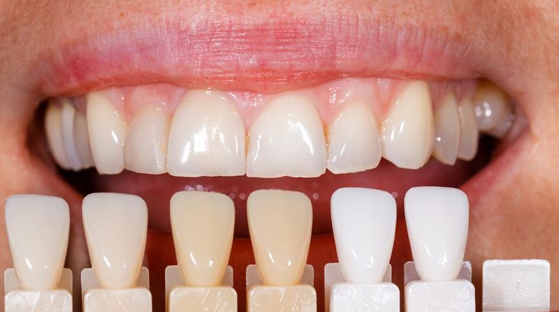 Veneers  Towson, MD 
